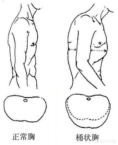 心脏病的早期症状及其识别