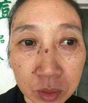 怎样保养老年斑的方法，探索预防与护理的最佳策略