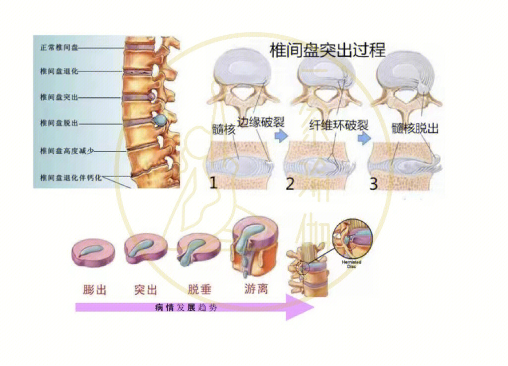 腰椎间盘突出，理解、预防与治疗