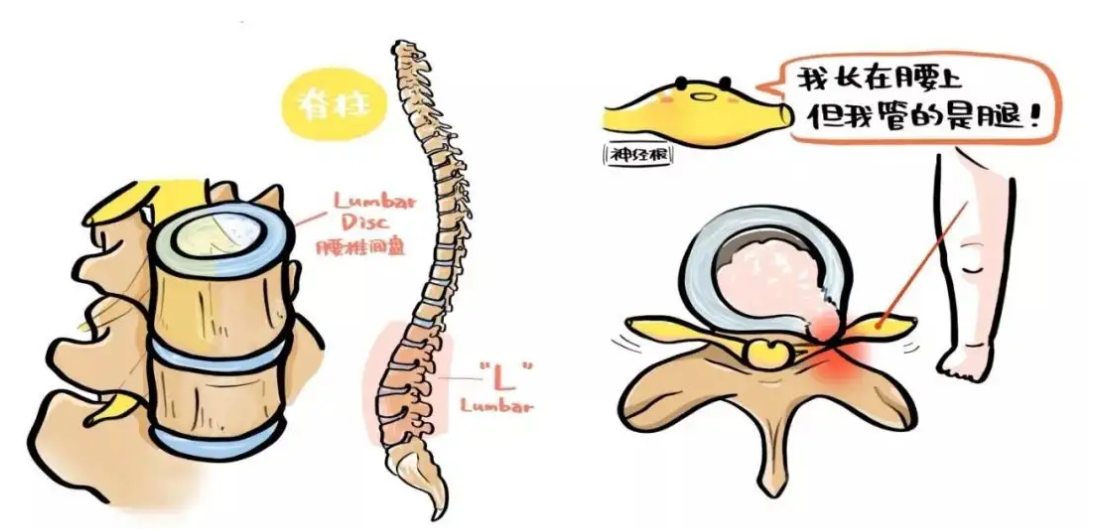 腰椎间盘突出，理解、预防与治疗