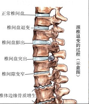 颈椎病的发病因素及其影响