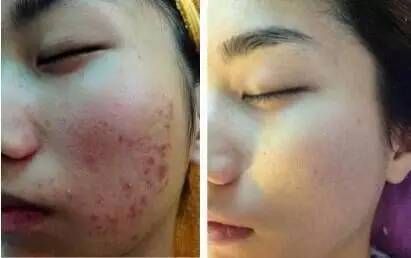 中医治疗痤疮，慎清热，兼顾整体调理